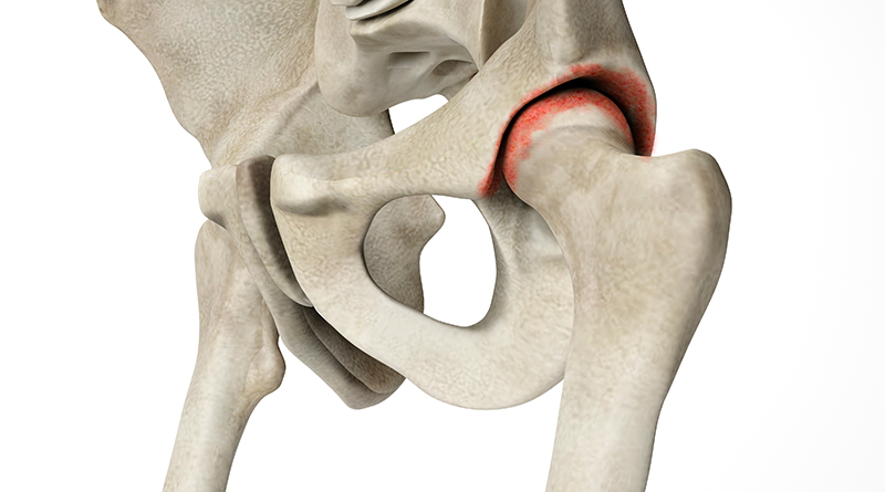 Síntomas y manifestaciones de la artrosis de cadera: todo lo que necesitas saber.